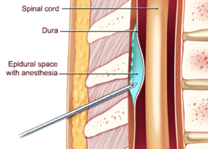 Epidural Injection Boca Raton