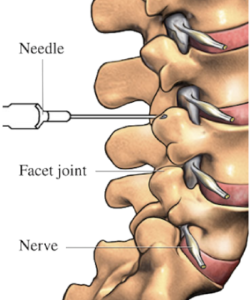 Facet Injections Boca Raton