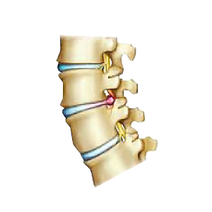 Herniated Disc Condition Boca Raton Spine Center