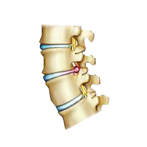 Herniated Disc