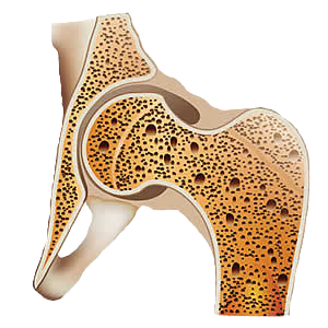Osteoporosis Treatment Boca Raton