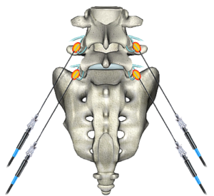 Radio Frequency Ablation Boca Raton