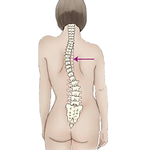 Scoliosis Treatment - Boca Raton