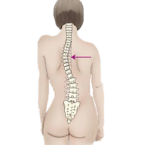 Scoliosis