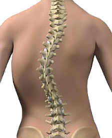 Scoliosis Boca Raton