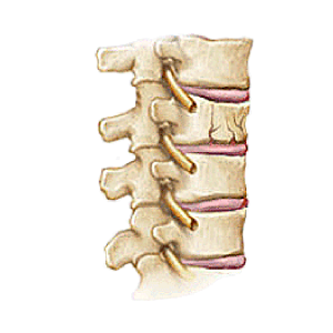 Spinal Fracture