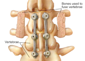 Spinal Compression Boca Raton