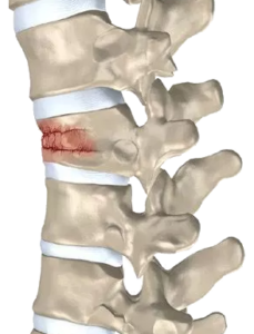 Vertebral Compression Fractures Boca Raton