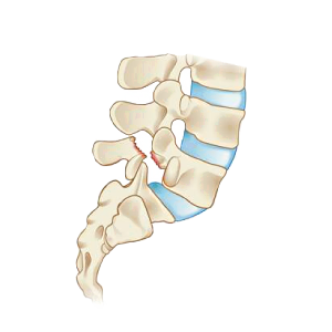 Spondylolisthesis