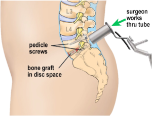 Minimally Invasive Procedure - Boca Raton