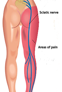 Sciatica