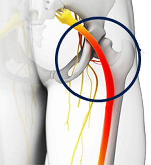 Sciatica: Symptoms, Causes and Treatment