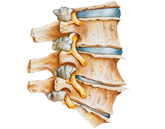 Degenerative-Disc-Disease