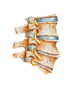 Degenerative-Disc-Disease