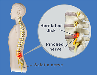 Pinched nerve vs. herniated disc: What's the difference?