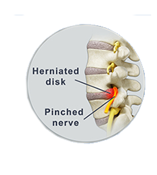 Pinched Nerve