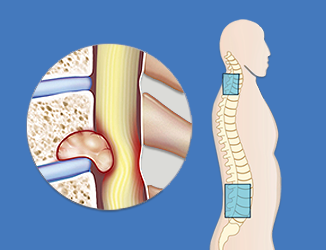 Spinal-Tumor