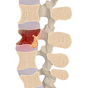 Spinal Osteomyelitis