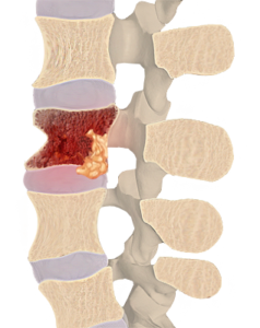 Osteomyelitis-spine-infection