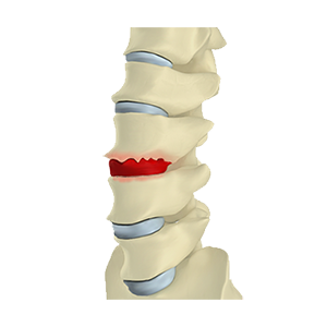 Bone Spur