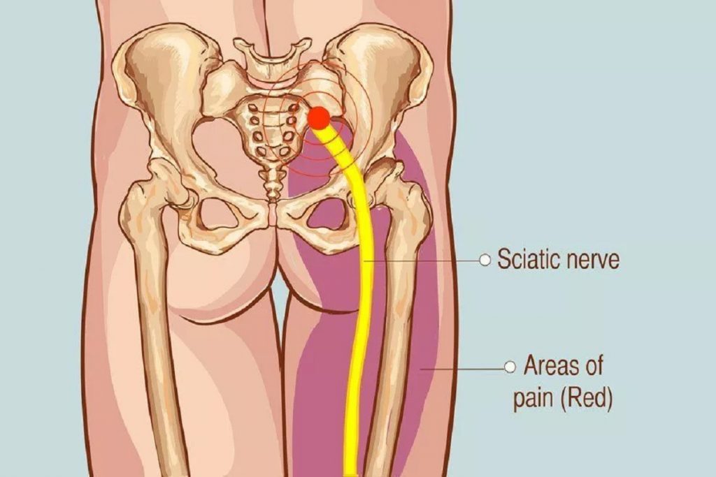 Association Between Sciatica and Buttock Pain